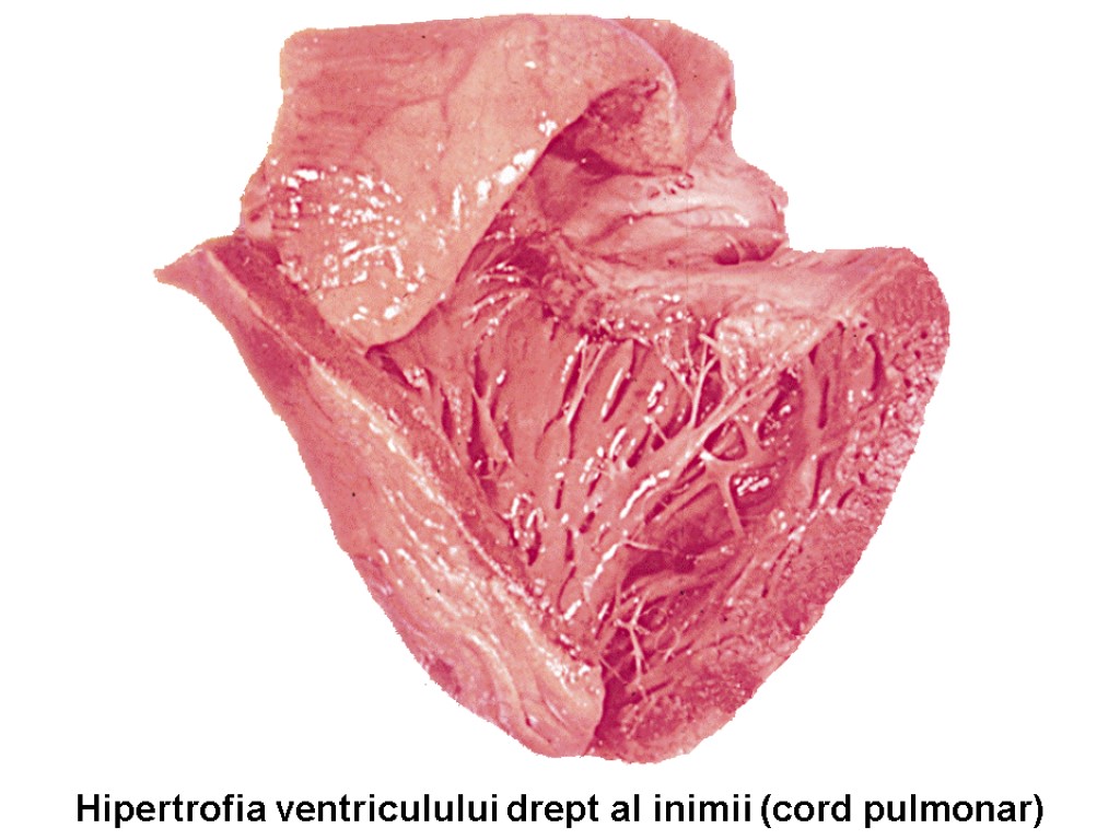 Hipertrofia ventriculului drept al inimii (cord pulmonar)